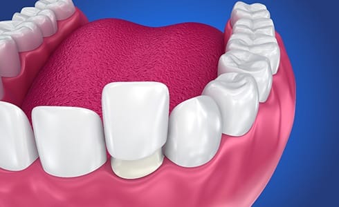 Digital image of a porcelain veneer being placed over a regular tooth on the bottom arch of teeth