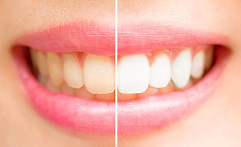 Close up of smile before and after whitening