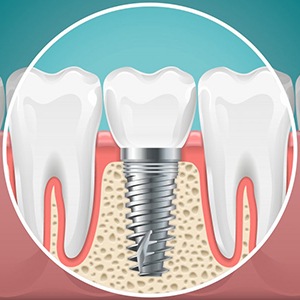 dentists performing dental implant surgery 