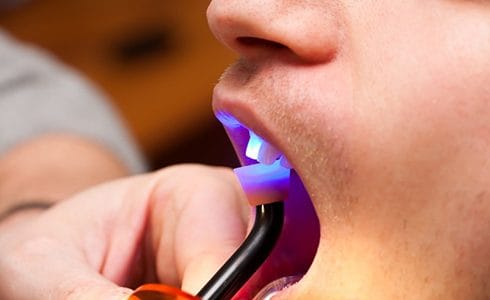 close up of man getting dental bonding hardened with curing light 