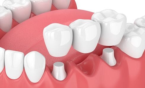 dental bridge being used to replace three missing bottom teeth 