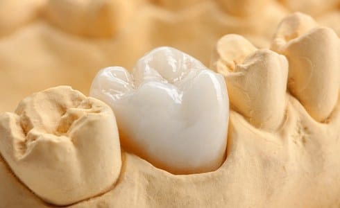 Model smile with dental crown restoration