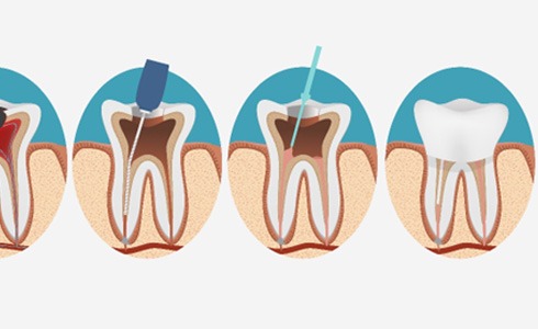 illustration for root canal therapy in Oklahoma City  
