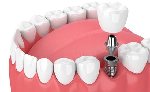 dental implant being placed in the lower jaw