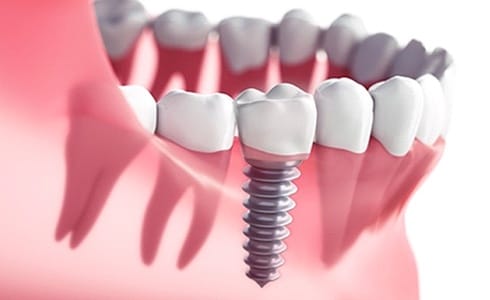 dental implant in the jaw