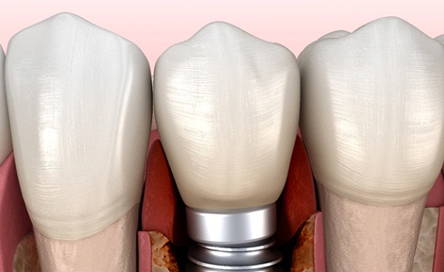 Failed dental implant in Oklahoma City