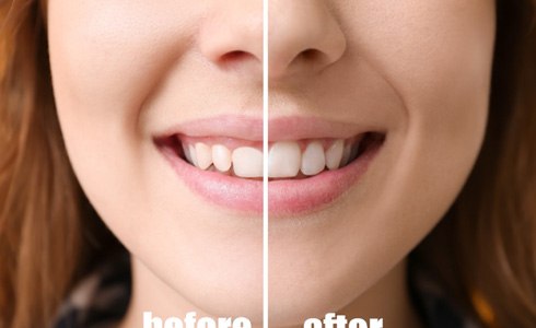 patient before and after gum recontouring  