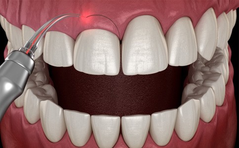 3D illustration of gum recontouring   