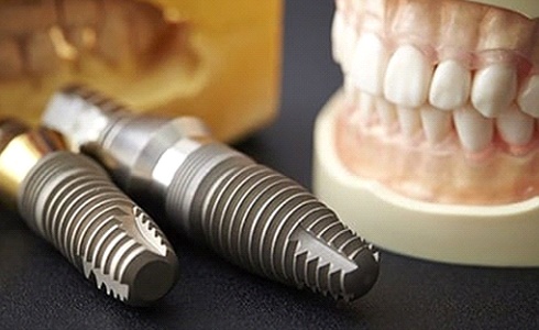 two dental implants in Oklahoma City on a table next to a set of dentures