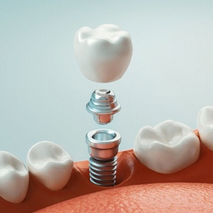 the three parts of a dental implant