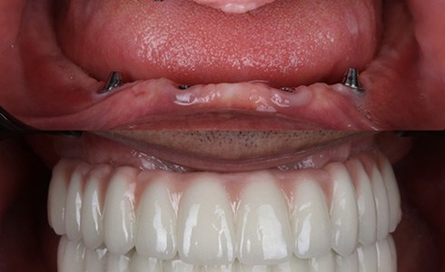 Implant dentures secure to the jaw via four to six dental implant posts for a more permanent fit