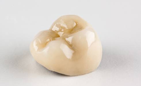 An example of a metal-free dental crown created to be placed over a person’s weakened tooth