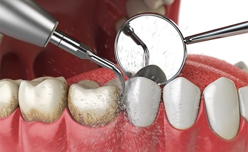 Animated periodontal maintenance process