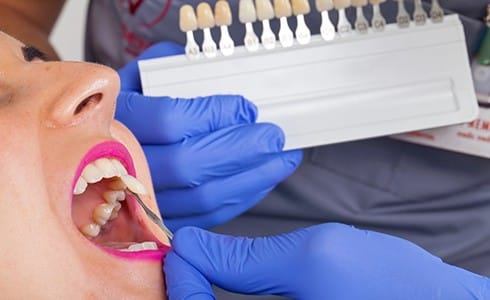 A dentist using a shade guide to identify the proper color for a woman’s new veneers