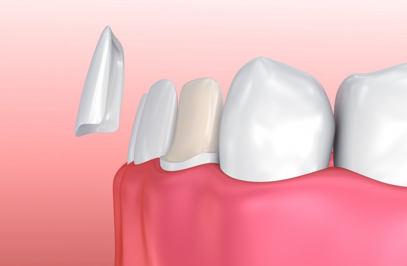 3D illustration of dental veneer