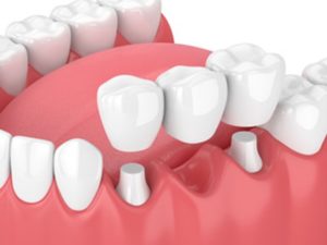 Illustration of a dental bridge being placed.